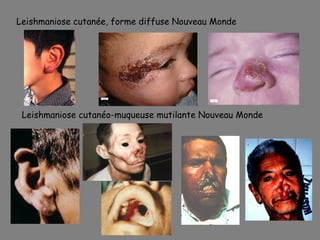 Leishmaniose cutanée, forme diffuse Nouveau Monde




 Leishmaniose cutanéo-muqueuse mutilante Nouveau Monde
 