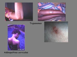 Trypanomes




Adénopathies cervicales
 