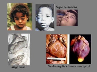 Signe de Ramana




Méga côlon   Cardiomégalie et aneurisme apical
 