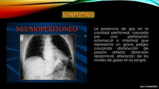 La presencia de gas en la
cavidad peritoneal, causada
por una perforación
estomacal o intestinal que
representa un grave peligro
causando disminución de
presión arterial, distensión
abdominal, alteración de los
niveles de gases en la sangre.
JESLY CHAMORRO
 