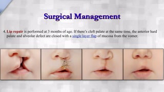 Management of Cleft Lip and Cleft Palate | PDF
