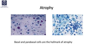 Basal and parabasal cells are the hallmark of atrophy
Atrophy
 