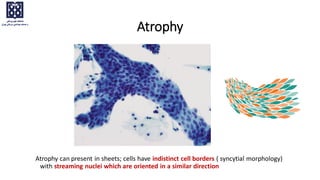 Atrophy can present in sheets; cells have indistinct cell borders ( syncytial morphology)
with streaming nuclei which are oriented in a similar direction
Atrophy
 