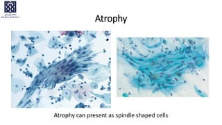 Atrophy
Atrophy can present as spindle shaped cells
 