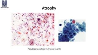 Atrophy
Pseudoparakeratosis in atrophic vaginitis
 