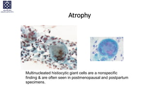 Multinucleated histiocytic giant cells are a nonspecific
finding & are often seen in postmenopausal and postpartum
specimens.
Atrophy
 