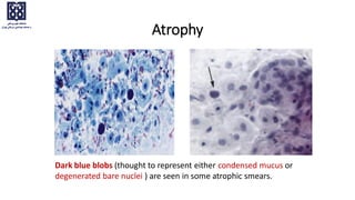 Dark blue blobs (thought to represent either condensed mucus or
degenerated bare nuclei ) are seen in some atrophic smears.
Atrophy
 