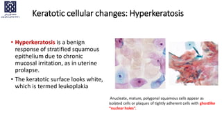 Keratotic cellular changes: Hyperkeratosis
• Hyperkeratosis is a benign
response of stratified squamous
epithelium due to chronic
mucosal irritation, as in uterine
prolapse.
• The keratotic surface looks white,
which is termed leukoplakia
Anucleate, mature, polygonal squamous cells appear as
isolated cells or plaques of tightly adherent cells with ghostlike
“nuclear holes”.
 