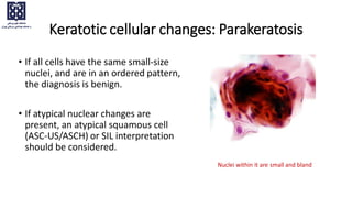 • If all cells have the same small-size
nuclei, and are in an ordered pattern,
the diagnosis is benign.
• If atypical nuclear changes are
present, an atypical squamous cell
(ASC-US/ASCH) or SIL interpretation
should be considered.
Keratotic cellular changes: Parakeratosis
Nuclei within it are small and bland
 