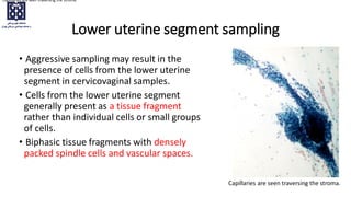 Lower uterine segment sampling
• Aggressive sampling may result in the
presence of cells from the lower uterine
segment in cervicovaginal samples.
• Cells from the lower uterine segment
generally present as a tissue fragment
rather than individual cells or small groups
of cells.
• Biphasic tissue fragments with densely
packed spindle cells and vascular spaces.
Capillaries are seen traversing the stroma.
Capillaries are seen traversing the stroma.
 