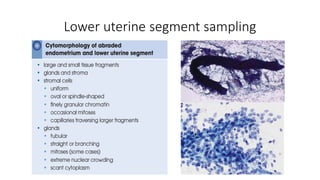 Lower uterine segment sampling
 