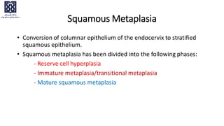 • Conversion of columnar epithelium of the endocervix to stratified
squamous epithelium.
• Squamous metaplasia has been divided into the following phases:
- Reserve cell hyperplasia
- Immature metaplasia/transitional metaplasia
- Mature squamous metaplasia
Squamous Metaplasia
 