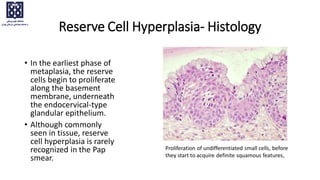 • In the earliest phase of
metaplasia, the reserve
cells begin to proliferate
along the basement
membrane, underneath
the endocervical-type
glandular epithelium.
• Although commonly
seen in tissue, reserve
cell hyperplasia is rarely
recognized in the Pap
smear.
Reserve Cell Hyperplasia- Histology
Proliferation of undifferentiated small cells, before
they start to acquire definite squamous features,
 
