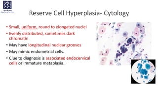 Reserve Cell Hyperplasia- Cytology
• Small, uniform, round to elongated nuclei
• Evenly distributed, sometimes dark
chromatin
• May have longitudinal nuclear grooves
• May mimic endometrial cells.
• Clue to diagnosis is associated endocervical
cells or immature metaplasia.
 