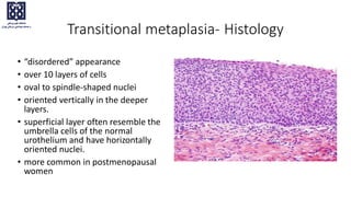 Transitional metaplasia- Histology
• “disordered” appearance
• over 10 layers of cells
• oval to spindle-shaped nuclei
• oriented vertically in the deeper
layers.
• superficial layer often resemble the
umbrella cells of the normal
urothelium and have horizontally
oriented nuclei.
• more common in postmenopausal
women
 