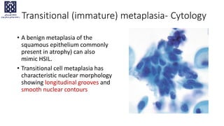 • A benign metaplasia of the
squamous epithelium commonly
present in atrophy) can also
mimic HSIL.
• Transitional cell metaplasia has
characteristic nuclear morphology
showing longitudinal grooves and
smooth nuclear contours
Transitional (immature) metaplasia- Cytology
 