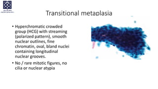 Transitional metaplasia
• Hyperchromatic crowded
group (HCG) with streaming
(polarized pattern), smooth
nuclear outlines, fine
chromatin, oval, bland nuclei
containing longitudinal
nuclear grooves.
• No / rare mitotic figures, no
cilia or nuclear atypia
 