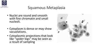 Squamous Metaplasia
• Nuclei are round and smooth
with fine chromatin and small
nucleoli.
• Cytoplasm is dense or may show
vacuolations.
• Cytoplasmic projections that look
like “spider legs” may be seen as
a result of sampling
 