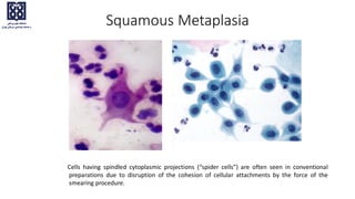 Cells having spindled cytoplasmic projections (“spider cells”) are often seen in conventional
preparations due to disruption of the cohesion of cellular attachments by the force of the
smearing procedure.
Squamous Metaplasia
 