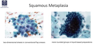 more rounded groups in liquid-based preparations
two-dimensional sheets in conventional Pap smears
Squamous Metaplasia
 