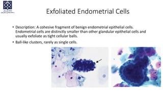 Exfoliated Endometrial Cells
• Description: A cohesive fragment of benign endometrial epithelial cells.
Endometrial cells are distinctly smaller than other glandular epithelial cells and
usually exfoliate as tight cellular balls.
• Ball-like clusters, rarely as single cells.
 