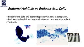 Endometrial Cells vs Endocervical Cells
• Endometrial cells are packed together with scant cytoplasm.
• Endocervical cells form looser clusters and are more abundant
cytoplasm
 