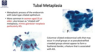 Tubal Metaplasia
• Metaplastic process of the endocervix
with tubal-type ciliated epithelium
• More common in women aged 35 or
older; also known as “ciliated cell”
metaplasia, mimics glandular neoplasia
particularly AIS.
Columnar ciliated endocervical cells that may
occur in small groups or as pseudostratified
crowded groups almost appear to form a
feathered border, a feature that is associated
with AIS.
 