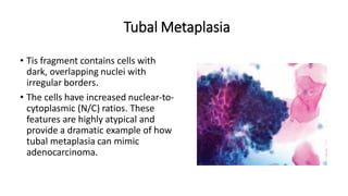 • Tis fragment contains cells with
dark, overlapping nuclei with
irregular borders.
• The cells have increased nuclear-to-
cytoplasmic (N/C) ratios. These
features are highly atypical and
provide a dramatic example of how
tubal metaplasia can mimic
adenocarcinoma.
Tubal Metaplasia
 