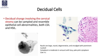 Decidual Cells
• Decidual change involving the cervical
stroma can be sampled and resemble
epithelial cell abnormalities, both LSIL
and HSIL.
Nuclei are large, round, degenerative, and smudged with prominent
nucleoli
Cytoplasm is moderate in amount with lacy, pale-pink cytoplasm
Low n:c
 