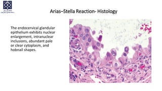 The endocervical glandular
epithelium exhibits nuclear
enlargement, intranuclear
inclusions, abundant pale
or clear cytoplasm, and
hobnail shapes.
Arias–Stella Reaction- Histology
 