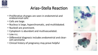 Arias–Stella Reaction
• Proliferative changes are seen in endometrial and
endocervical cells
• Cells are large.
• Nucleus is large, hyperchromatic, and multilobated.
• Nucleoli are prominent.
• Cytoplasm is abundant and multivacuolated.
• Low n:c.
• Differential diagnosis includes endometrial and clear-
cell carcinoma
• Clinical history of pregnancy may prove helpful
 