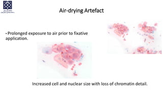 Air-drying Artefact
• Prolonged exposure to air prior to fixative
application.
Increased cell and nuclear size with loss of chromatin detail.
 