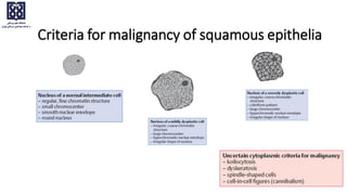 Criteria for malignancy of squamous epithelia
 