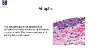 Atrophy
The cervical squamous epithelium is
remarkably thinned and made up entirely of
parabasal cells. This is a consequence of
waning hormonal support.
 