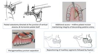 7 MIDFACE ORTHOGNATHIC PROCEDURE seminar 7.pptx