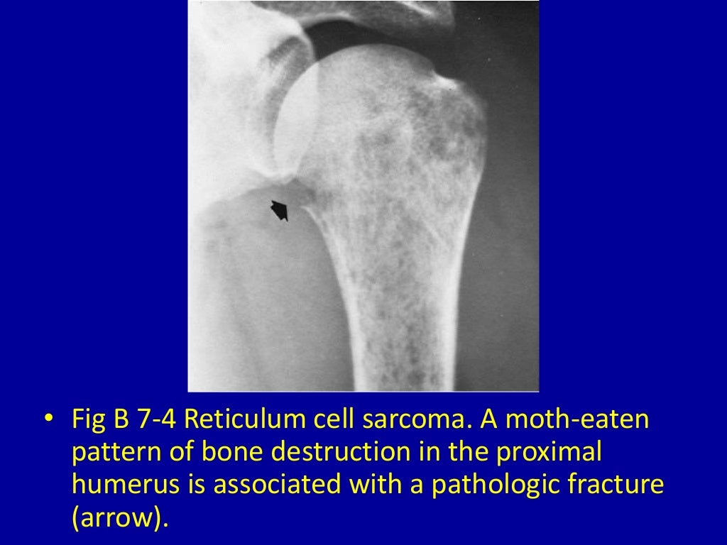 7 moth eaten or punchedout osteolytic destructive lesions of