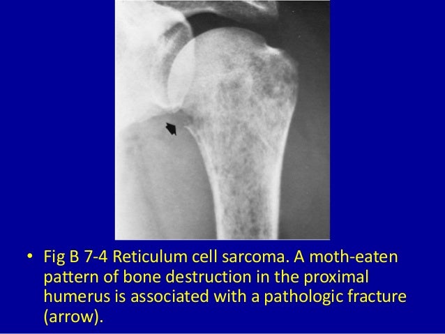 7 moth eaten or punchedout osteolytic destructive lesions of