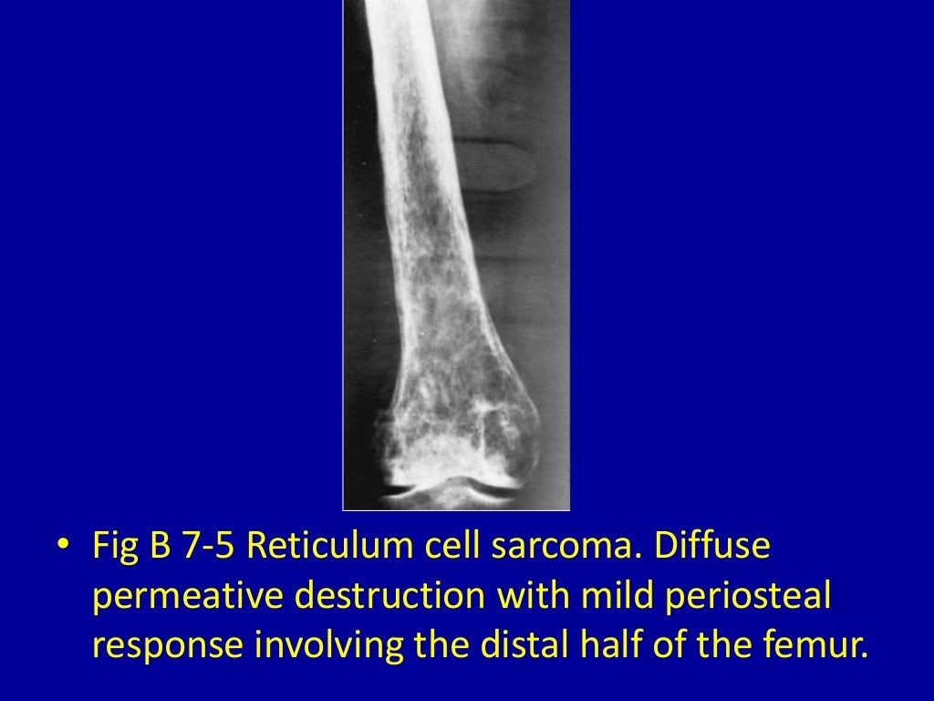 7 moth eaten or punchedout osteolytic destructive lesions of