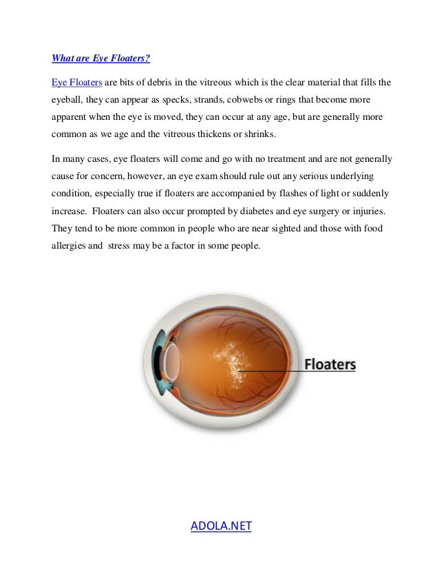 How do you remove eye floaters?
