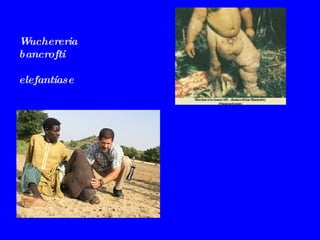 Wuchereria bancrofti elefantíase 