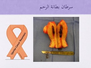 ‫الرحم‬ ‫بطانة‬ ‫سرطان‬
 