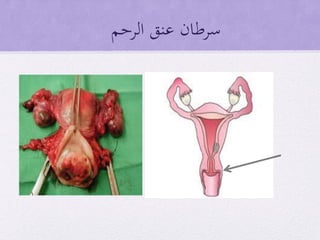 ‫الرحم‬ ‫عنق‬ ‫سرطان‬
 