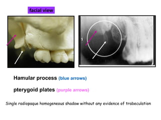 7 Normal Anatomical Landmarks OF MAXIILA AND MANDIBLE.ppt