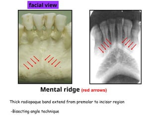 Lr Mandibular Ridge 7 Normal Anatomical Landmarks OF MAXIILA AND MANDIBLE.ppt