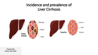 Incidence and prevalence of
Liver Cirrhosis
Prepared by:
Shnyar Atta Qadir
 