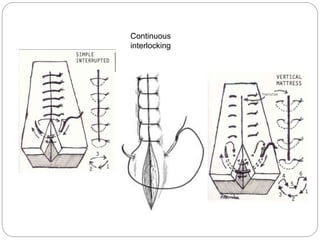 Bedside Procedure | PPTX