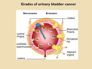 Non-invasive
Grades of urinary bladder cancer
Invasive
 