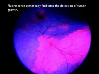 Fluorescence cystoscopy facilitates the detection of tumor
growth.
 