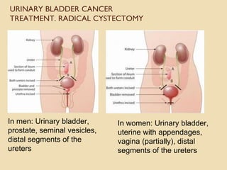URINARY BLADDER CANCER
TREATMENT. RADICAL CYSTECTOMY
In men: Urinary bladder,
prostate, seminal vesicles,
distal segments of the
ureters
In women: Urinary bladder,
uterine with appendages,
vagina (partially), distal
segments of the ureters
 