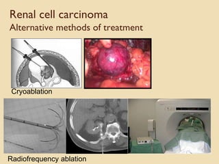 Renal cell carcinoma
Alternative methods of treatment
Cryoablation
Radiofrequency ablation
 